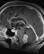 Image result for Ependymoma C72.0. Size: 151 x 185. Source: www.ars-neurochirurgica.com