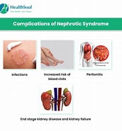 Image result for Invitae Nephrotic Syndrome. Size: 172 x 185. Source: healthsoul.com