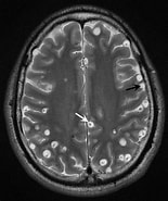 Image result for Neurocysticercose. Size: 155 x 185. Source: pn.bmj.com