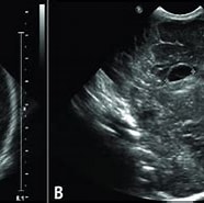 Image result for Subependymale Zyste nach Hirnblutung 1. Grades. Size: 186 x 137. Source: www.researchgate.net