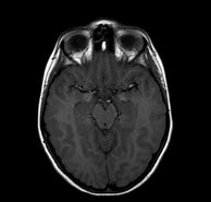 Image result for Neurokutane Melanose im Kindesalter. Size: 194 x 185. Source: pacs.de