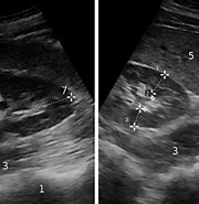 Image result for Transiente Kortikomedullaere Echogenitaetserhoehung der Neugeborenen-niere. Size: 180 x 168. Source: www.doccheck.com