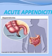 Bildresultat för Gangränöse Appendizitis. Storlek: 171 x 185. Källa: www.vrogue.co