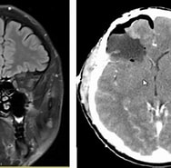 Bildergebnis für Dnet Dysembryoplastischer neuroepithelialer tumor. Größe: 188 x 176. Quelle: www.stechisonneurosurgery.com