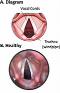 Bildergebnis für Submuköses Hämangiom der subglottischen trachea. Größe: 120 x 185. Quelle: www.researchgate.net
