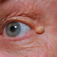 Image result for Epidermoid In der Kalotte. Size: 187 x 185. Source: healthjade.com