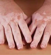 Image result for Vitiligo Disease Opzelura. Size: 173 x 185. Source: xtalks.com