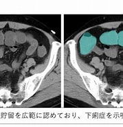 腸管 浮腫 CT に対する画像結果.サイズ: 179 x 185。ソース: xn--o1qq22cjlllou16giuj.jp