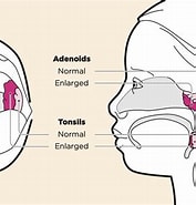 Image result for Normal Tonsils and Adenoids. Size: 177 x 185. Source: www.upopolis.com