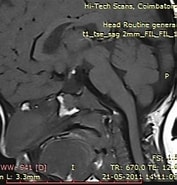 Image result for ektope Neurohypophyse. Size: 177 x 185. Source: pacs.de