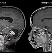 Image result for Infratentorielles Pilozytisches Astrozytom. Size: 182 x 185. Source: neurochirurgie.insel.ch