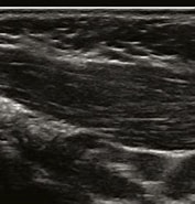 Image result for Sternocleidomastoid muscle on ultrasound. Size: 177 x 185. Source: www.researchgate.net
