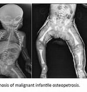 Afbeeldingsresultaten voor Osteopetrose Infantiler, Maligner Typ, Marmorknochenkrankheit. Grootte: 175 x 185. Bron: preventive-medicine.imedpub.com