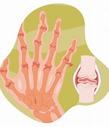 Image result for Reumatismo Articular agudo. Size: 158 x 185. Source: www.imske.com