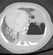 Image result for Zystisch adenomatoide malformation der Lunge. Size: 176 x 185. Source: pet-ct.com