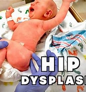 Bildergebnis für Baby Dysplasia. Größe: 172 x 185. Quelle: www.youtube.com