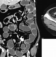 腸管 浮腫 CT に対する画像結果.サイズ: 182 x 184。ソース: www.researchgate.net