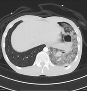 Image result for posttraumatische Pneumatocele Im Ligamentum Pulmonale Inferior. Size: 177 x 185. Source: radiopaedia.org
