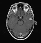 Bildergebnis für Dnet Dysembryoplastischer neuroepithelialer tumor. Größe: 176 x 185. Quelle: pacs.de