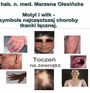 Image result for Choroby_układowe_tkanki_łącznej. Size: 180 x 185. Source: www.youtube.com