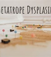 Image result for Metatropische Dysplasie. Size: 164 x 181. Source: www.diseasemaps.org