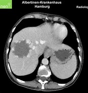 Image result for Infantiles Leberhämangioendotheliom - Hämangiomatose der Leber. Size: 174 x 185. Source: www.doccheck.com