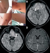 Image result for Neurokutane Melanose im Kindesalter. Size: 175 x 185. Source: www.scielo.br