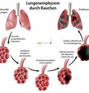 Image result for Pulmonales interstitielles Emphysem nach Atemnotsyndrom Iv�. Size: 177 x 185. Source: captionsideasnl.blogspot.com