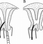 Risultato immagine per uterus Septum Entfernung. Dimensioni: 180 x 167. Fonte: www.fertstert.org