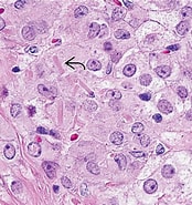Image result for Leydig-zell-tumor des Hodens. Size: 174 x 185. Source: basicmedicalkey.com