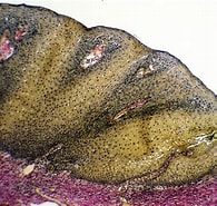 Image result for "obrimoposthia Acuminata". Size: 195 x 185. Source: www.infectiousdiseaseadvisor.com