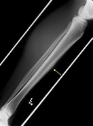 Image result for Stressfraktur Proximale Tibia. Size: 137 x 185. Source: www.svuhradiology.ie
