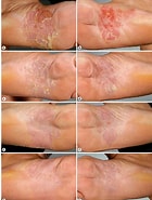 Image result for Palmoplantar Pustular Psoriasis.14. Size: 140 x 185. Source: www.semanticscholar.org