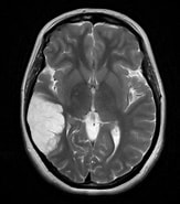 Bildergebnis für Dnet Dysembryoplastischer neuroepithelialer tumor. Größe: 163 x 185. Quelle: pacs.de