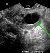 Image result for Neonatale gekammerte Ovarialzyste. Size: 174 x 185. Source: www.cyberdoktor.de