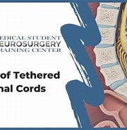 Image result for Tethered Spinal Cord Mit Einschluss-tm. Size: 180 x 185. Source: www.youtube.com