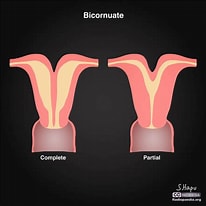 Image result for uterus bicornis bicollis. Size: 206 x 206. Source: radiopaedia.org