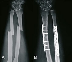 Schaftfraktur im Unterarm に対する画像結果.サイズ: 236 x 206。ソース: www.orthoforum.de