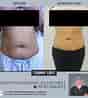 Before and After Tummy Tuck Surgery ପାଇଁ ପ୍ରତିଛବି ଫଳାଫଳ. ଆକାର: 88 x 98। ଉତ୍ସ: lujulu.weebly.com