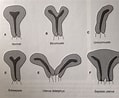 Image result for uterus bicornis bicollis. Size: 119 x 98. Source: www.pinterest.ca