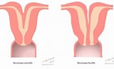 Image result for uterus bicornis bicollis. Size: 160 x 98. Source: europepmc.org