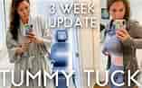 Before and After Tummy Tuck Surgery ପାଇଁ ପ୍ରତିଛବି ଫଳାଫଳ. ଆକାର: 157 x 98। ଉତ୍ସ: www.youtube.com