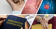 Image result for Hydentra Suppurativa. Size: 190 x 98. Source: www.rheumatologynetwork.com