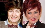 Image result for Sharon Osbourne Before Surgery. Size: 157 x 99. Source: viralsurgery.com