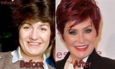 Image result for Sharon Osbourne Before Surgery. Size: 165 x 99. Source: viralsurgery.com