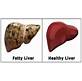 How To Resolve Fatty Liver