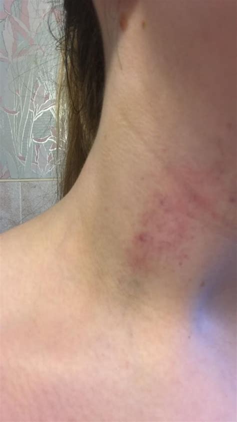 before how to get rid of a hickey popsugar beauty photo 2