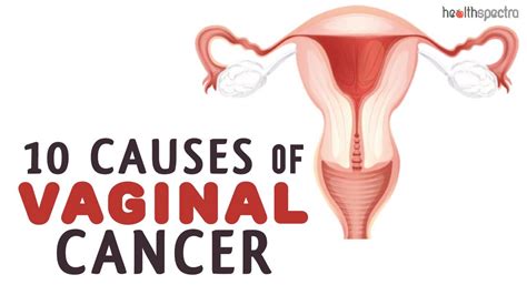 10 causes of vaginal cancer youtube