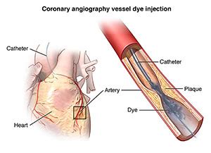 cardiac catheterization trinity medical wny