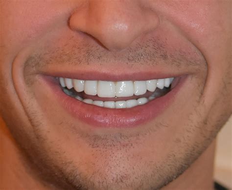 rechte tanden bij ons de mooiste tanden oud acta tandartsenverzekerd